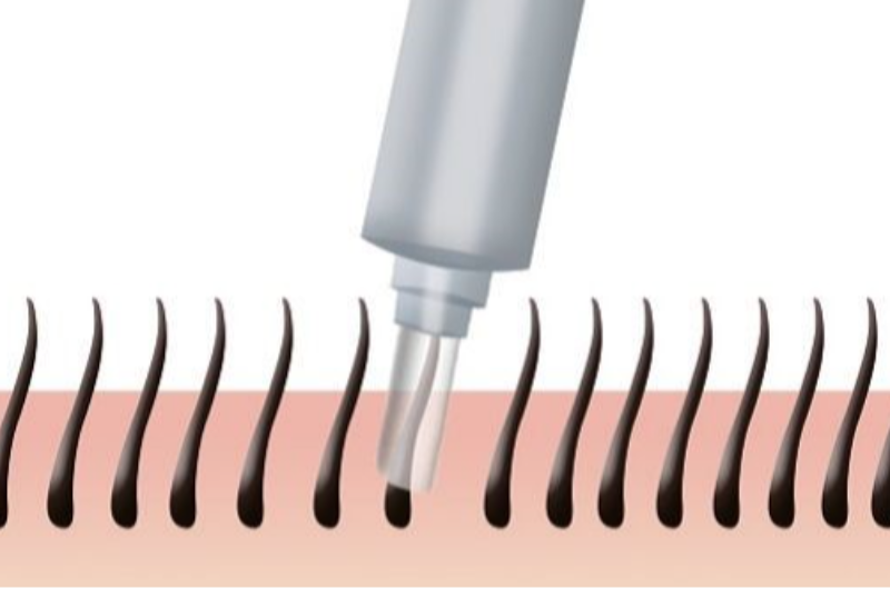 HAIR TRANSPLANT PACKAGE – ISTANBUL
