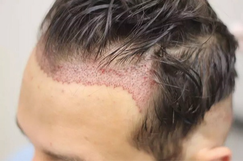 HAIR TRANSPLANT PACKAGE – ISTANBUL